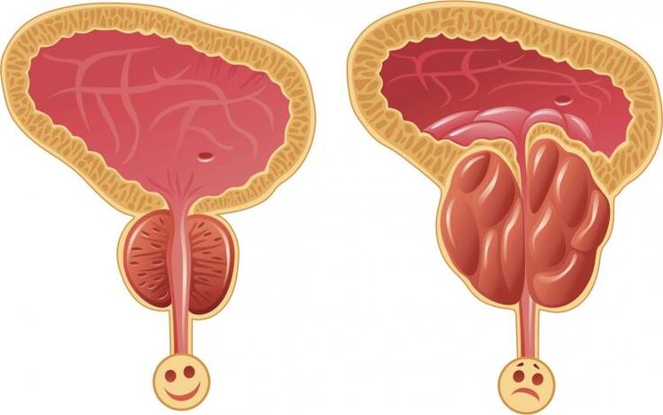 Gesunde Prostata und Prostatitis